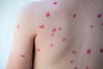Treatment of ulcers from chickenpox, chickenpox with a healing cream on the skin of a child. Close-up of a child's back treated with red medicine. - obrazy, fototapety, plakaty