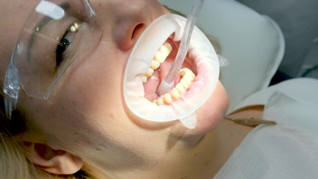 close-up woman dentistry brushing teeth cleaning removing plaque stones saliva ejector using oral mirrors newest technology sandblaster goggles water drops spilling to sides optragate mouth expander