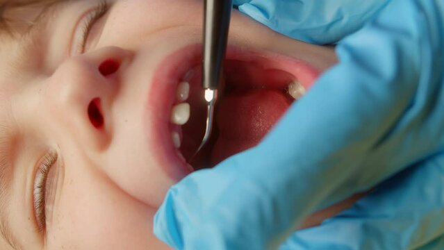 Open mouth child close-up at dentist. Dentist work with children. Close up hands dentist who makes brushing teeth ultrasound. Female professional dentist at work. Dental checkup concept. 