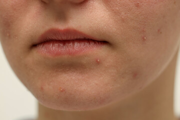 Young woman with acne on her face against white background, closeup