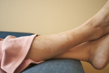  feet with vitiligo skin condition.