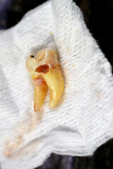 Extracted wisdom 8th lower right tooth with a teeth decay, after exposed nerve and severe pain,...