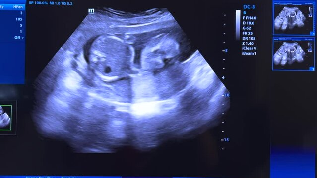 Footage Ultrasonography of 20 weeks pregnancy.
