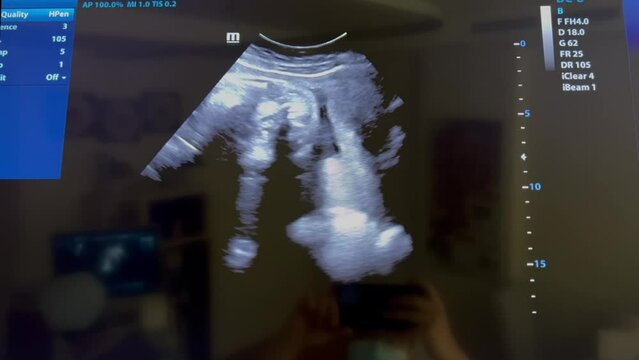 Footage Ultrasonography of 20 weeks pregnancy.