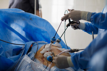 hands of doctors performing laparoscopy operations - obrazy, fototapety, plakaty
