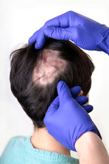 Child with Kerion fungal infection, suffering hair loss