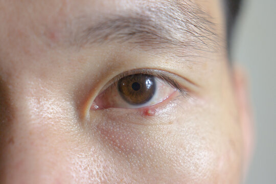 Close up eye brown with stye infection. Eyelid abscess, hordeolum in medical health.
