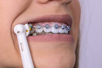 Close up dental braces system.