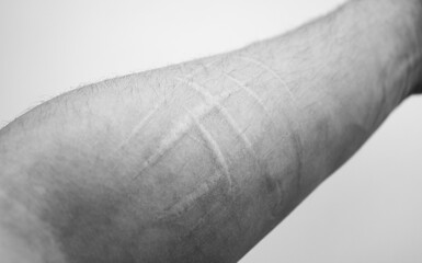 Scars from cuts on the arm. Old traces of a skin cut on the forearm.