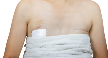 Surgical wound plaster - Needle localization excision, the position will be determined by ultrasound or mammogram then X-rayTrident validate. And breast cancer surgery scars by partial mastectomy. 