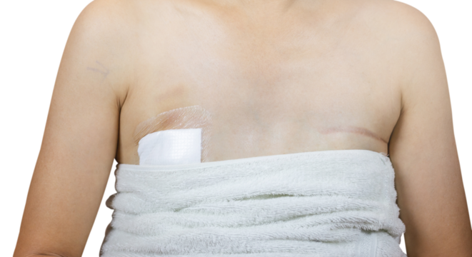 Surgical wound plaster - Needle localization excision, the position will be determined by ultrasound or mammogram then X-rayTrident validate. And breast cancer surgery scars by partial mastectomy. 