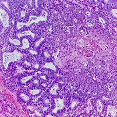 Camera photo of endometrioid carcinoma with squamous differentiation, magnification 200x,...