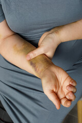 Moman supporting an arm with a significant bruise