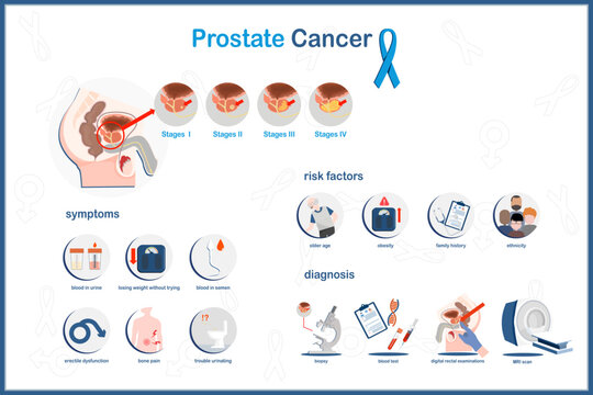 Flat vector concept Medical infographic illustration of prostate cancer.states of prostate cancer,symptoms,risk factors and diagnosis of prostate cancers.isolated on white background.