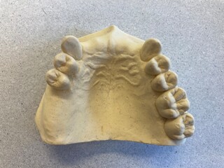 mandibular edentulism: Kennedy class II