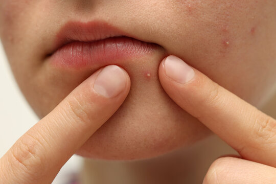 Young woman touching pimple on her face against white background, closeup. Acne problem