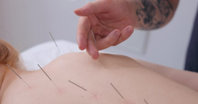 acupuncture therapy on spine, shoulders for female client. girl undergoing acupuncture treatment with fine needles inserted into slim body skin in clinic hospital, lying on couch Slow motion Close up