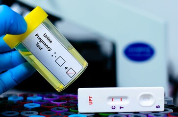 Urine sample of patient positive for pregnancy test by rapid diagnostic test.