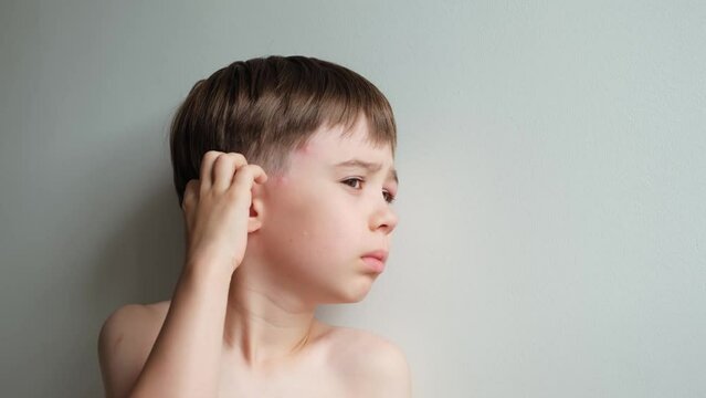 The boy looking at the camera rubbing and scratching head with a swollen eye from an insect bite. Close-up view. Angioedema. Allergic response. Red inflamed upper eyelid. Inflammation. Itching bites