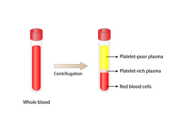 Platelet-rich plasma (prp). Autologous conditioned plasma, is a concentrate of platelet-rich plasma extracted from whole blood. After centrifugation, Extract PRP and Inject. Vector Illustration - obrazy, fototapety, plakaty