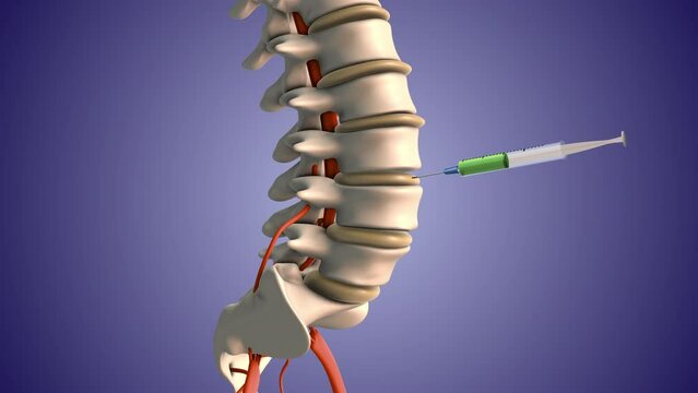 Injecting steroids to treat herniated disc pain