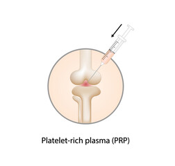 Platelet-rich plasma (prp). Autologous conditioned plasma, is a concentrate of PRP extracted from whole blood. After centrifugation, extract PRP and inject knee. Vector Illustration.