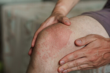 Rash or eczema on a man's knee, allergic reaction with red spots