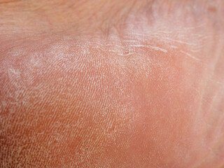Fototapeta premium Dry skin damaged macro shot of the surface