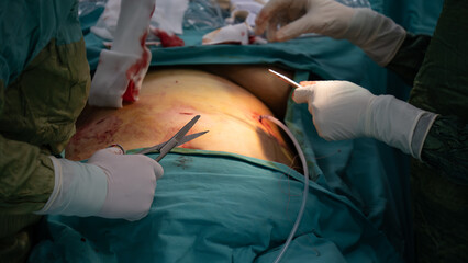 Laparoscopic surgery requires stitches after surgery. After the surgery, the doctor finishes the...