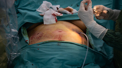 Laparoscopic surgery requires stitches after surgery. After the surgery, the doctor finishes the...