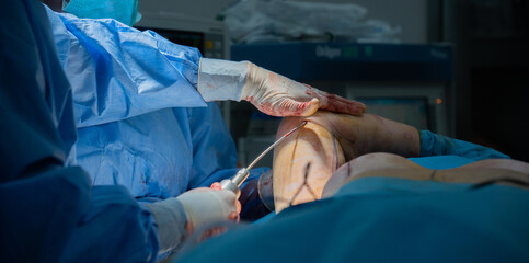 doctor doing arm liposuction. The arm is thinned with arm liposuction. Plastic surgery.