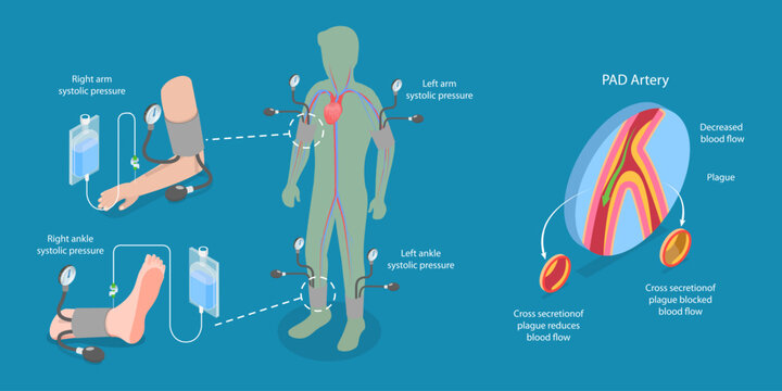 3D Isometric Flat Vector Illustration of ABI Test, Limb Ischemia Diagnosis