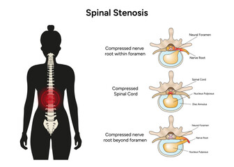 Spinal stenosis medical infographic in vector