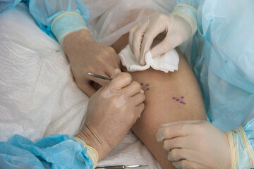 According to marked points for punctures, doctor makes neat incisions with surgical instrument on patient's leg. Close-up of the work of the medical team on the surgical treatment of varicose veins
