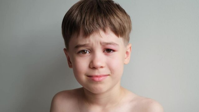 Unhappy portrait of little boy looking at the camera with a swollen eye from an insect bite close-up. Angioedema. Allergic response. Red inflamed upper eyelid. Disease or inflammation skin. Bee bite.