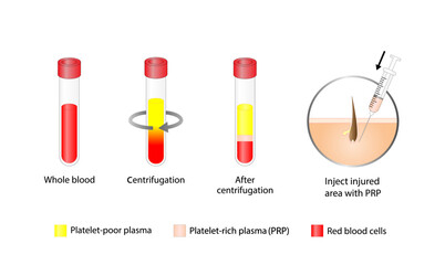 Platelet-rich plasma (prp). Autologous conditioned plasma, is a concentrate of PRP extracted from whole blood. After centrifugation, extract PRP and inject skin or hair. Vector Illustration.