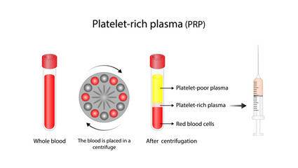 Platelet-rich plasma (prp). Autologous conditioned plasma, is a concentrate of PRP extracted from whole blood. After centrifugation, extract PRP and inject hair, skin or knee. Vector Illustration - obrazy, fototapety, plakaty