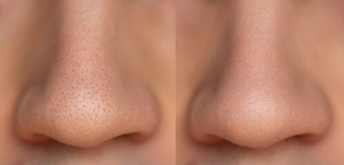Nose before and after cleansing from black dots. Taking care of the health of the facial skin....