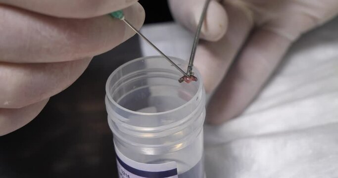 The doctor removes a piece of tissue from endoscopic forceps for histological examination into a container with formaldehyde. Endoscopic tissue biopsy for pathological examination.