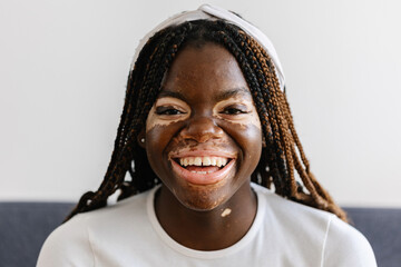 Portrait of happy young woman with vitiligo smile at camera sitting on sofa. Diversity and people concept