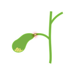 Gallbladder disease. Gallstones. Bile duct obstructions vector illustration.