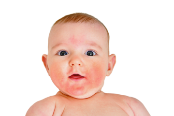 Portrait of a happy infant baby with allergies, red skin dermatitis, isolated on a white background. Kid aged four months