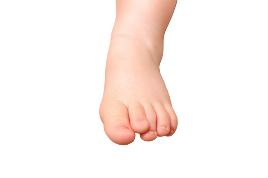 Deformed toes on the foot of the toddler baby, congenital curvature, isolated on a white background. Kid aged one year and three months