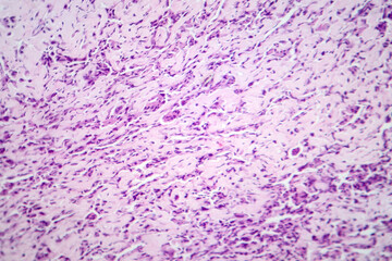 Osteosarcoma, a malignant bone tumor, light micrograph under the microscope