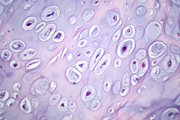 Photomicrograph of chondrosarcoma, showcasing the cellular details of this malignant cartilage...