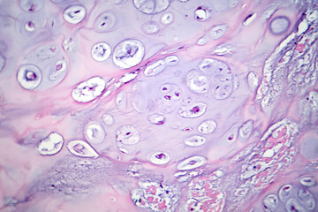 Photomicrograph of chondrosarcoma, showcasing the cellular details of this malignant cartilage...