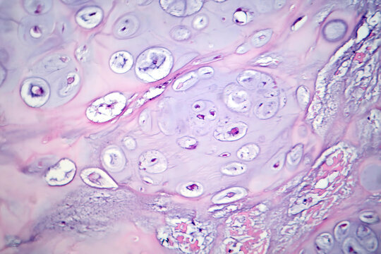 Photomicrograph of chondrosarcoma, showcasing the cellular details of this malignant cartilage tumor under the microscope