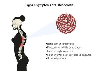 SIgns and symptoms of osteoporosis in vector
