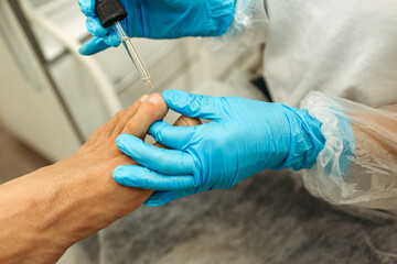 A doctor drops medicine from a pipette onto a sore finger. - obrazy, fototapety, plakaty