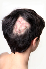 Child suffering with kerion hair loss